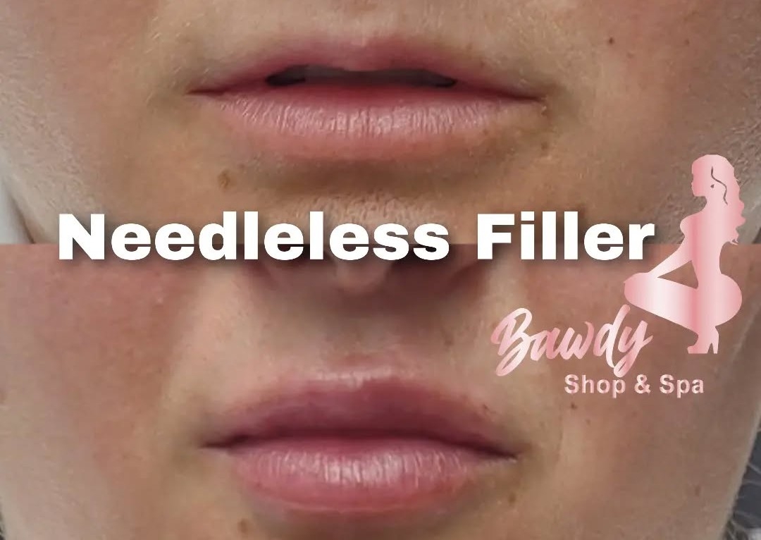 1 ml Needleless Lip Infusion