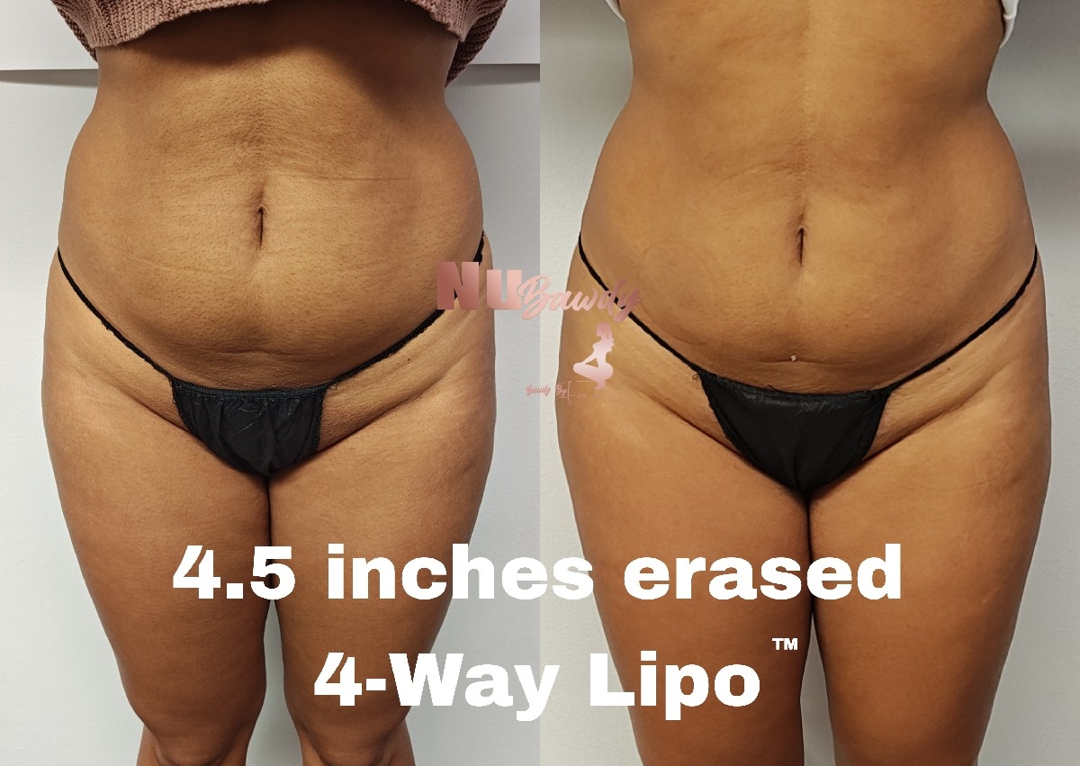 4-Way Lipo (8 Sessions)