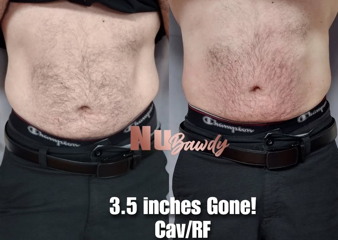 Cavitation & Radio Frequency