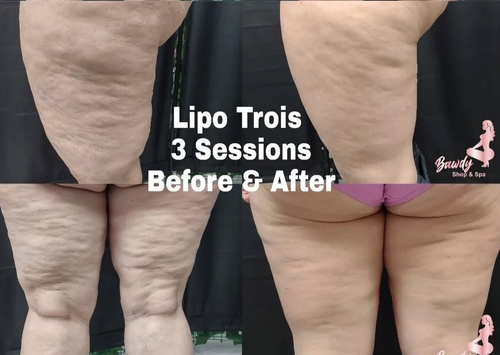 Xtreme Lipo (1 Session)