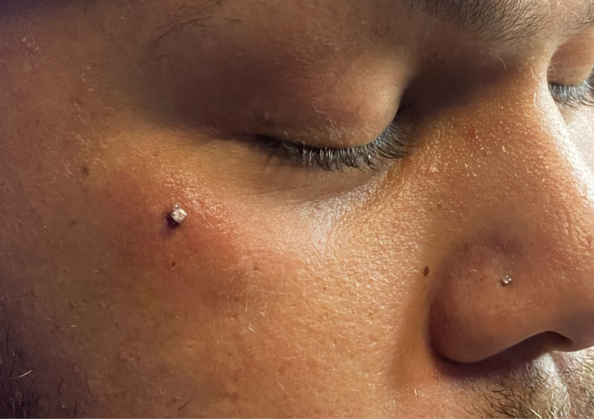 Tear Drop Dermal