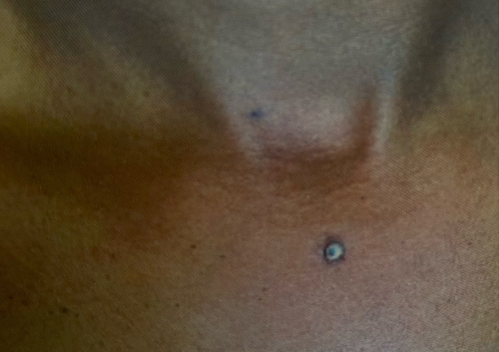 Chest Dermal