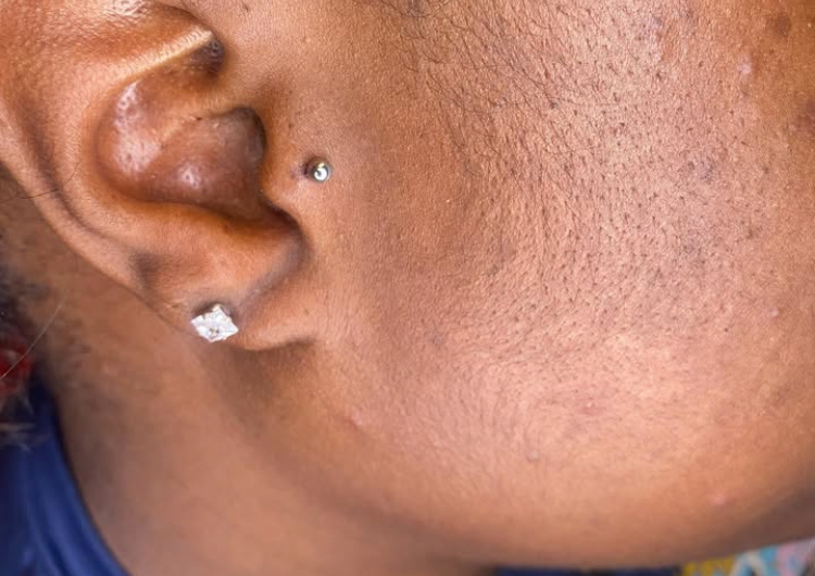 Tragus (one)