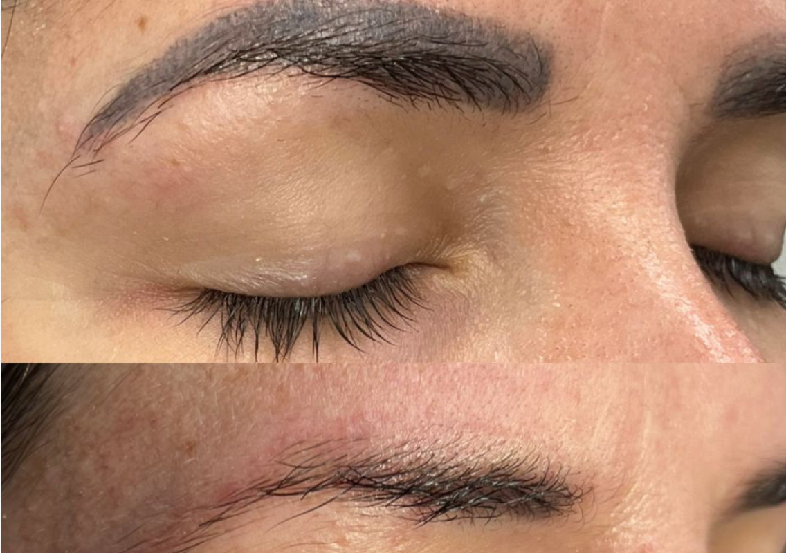 Sesion de Remocion de cejas tatuadas 