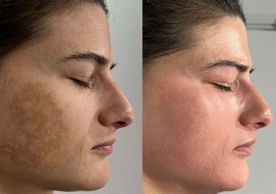 Peeling Facial Avanzado: Renovación Profunda para tu Piel