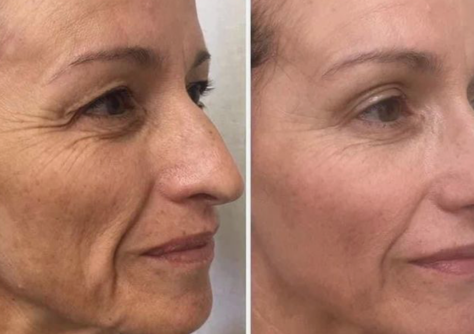 1 sesion Botox facial - Microcorriente 