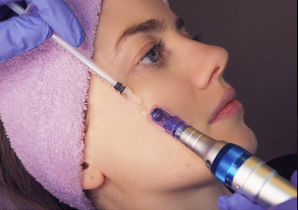 Dermapen / Micropunción - Tu piel renovada desde la primera sesión 