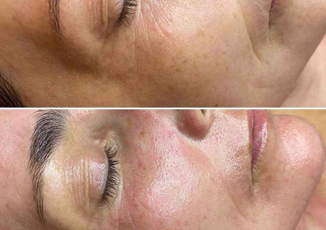 2 sesiones de botox facial - microcorriente 