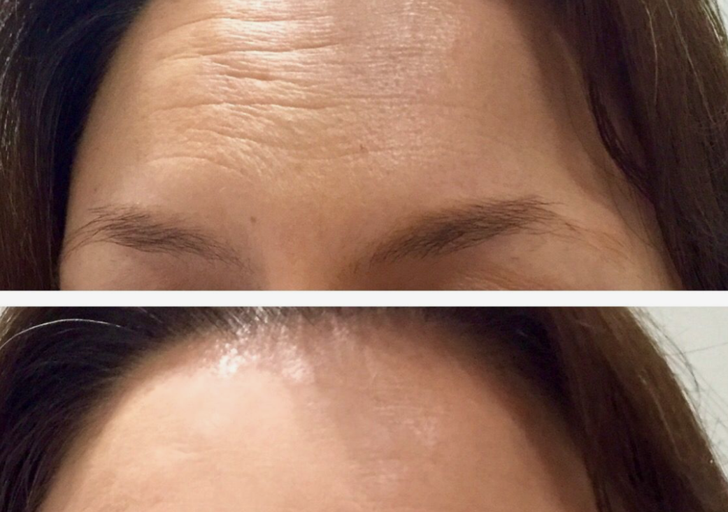 3 sesiones botox facial + kit de regalo de productos 