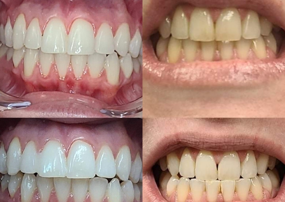 Teeth Whitening by Nancy Q 