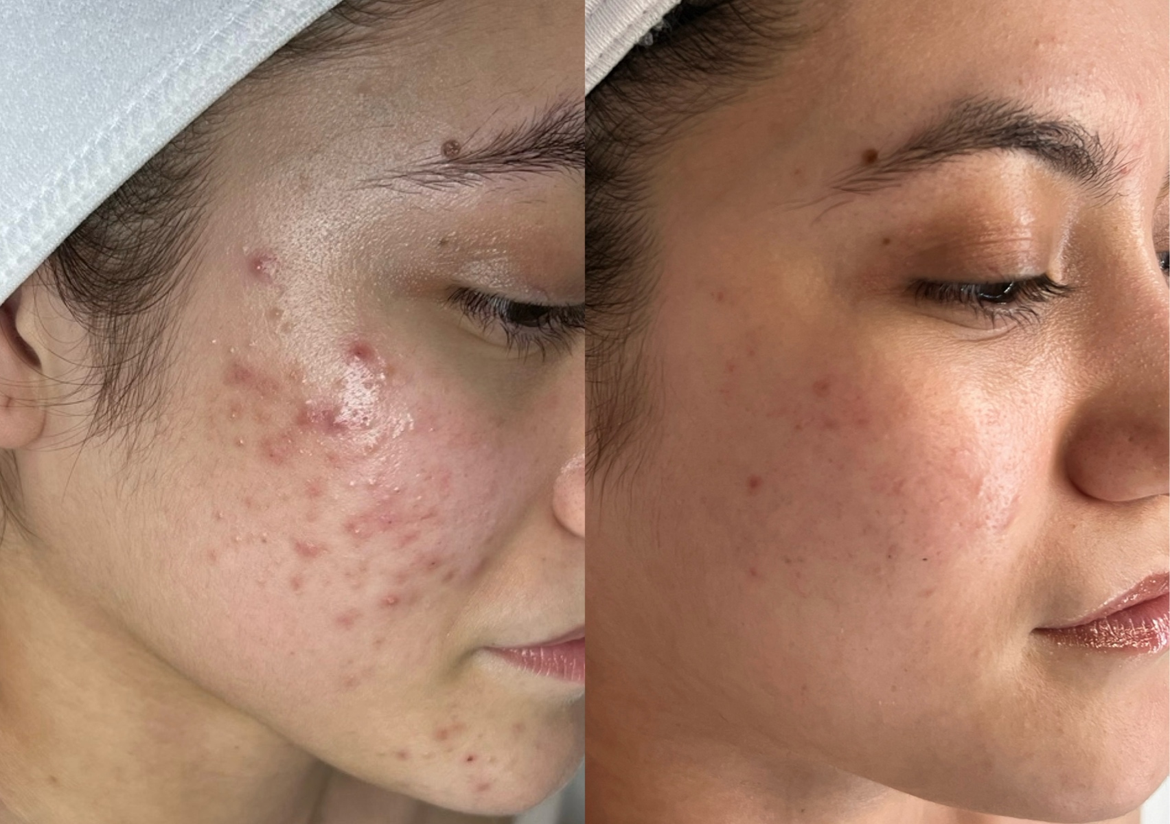 Acne Clearing Facial
