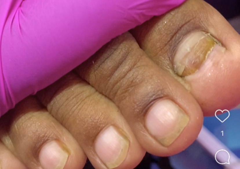 TOE NAIL REPLACEMENT 