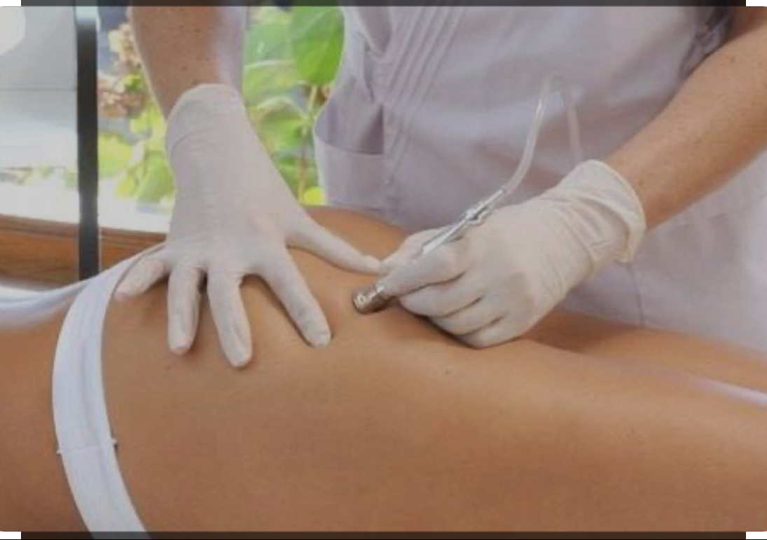 Microdermabrasión de Glúteos