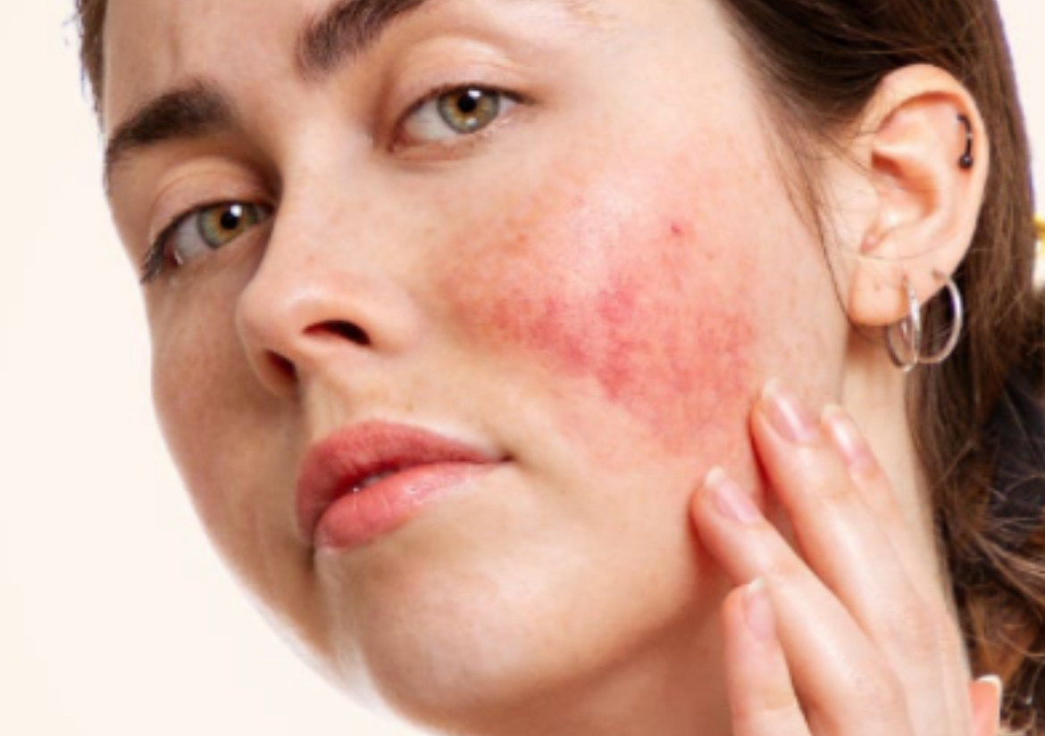 Rosacea Treatment/ Tratamiento Rosácea