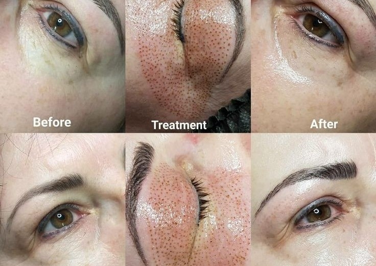 Plasma pen anti aging 
