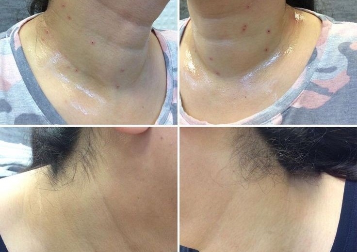 Skin tag removal,dark spots 