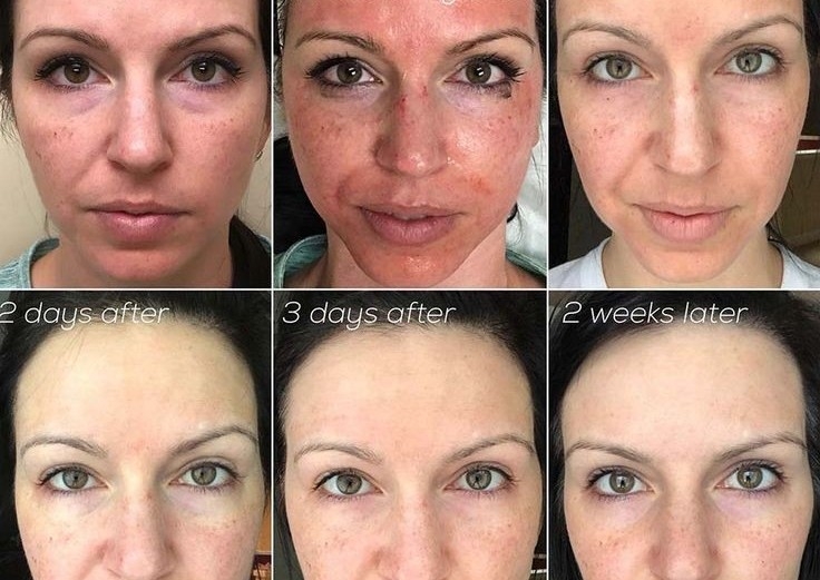 microneedling 
