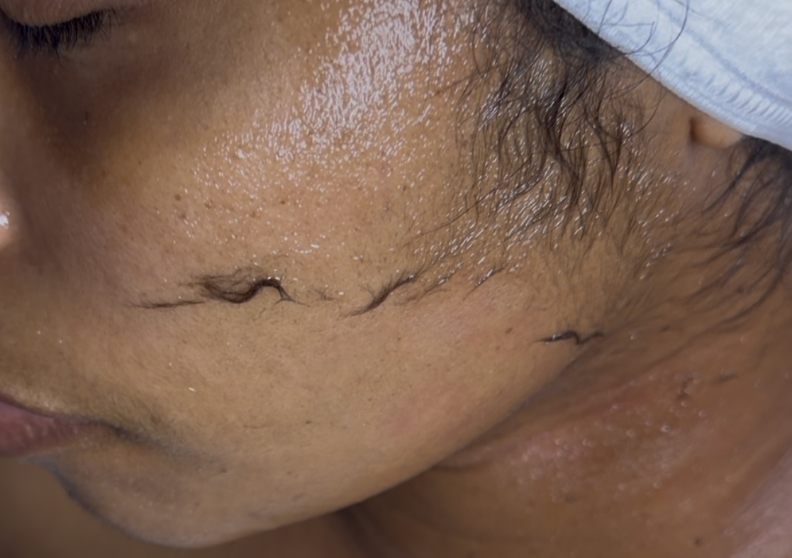 Dermaplaning 