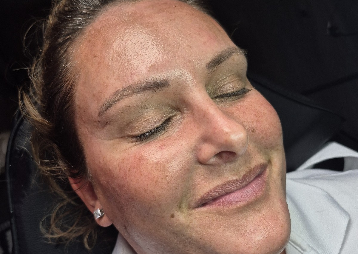 Chemical Peel Facial 