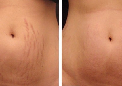 Stretchmark microneedling 