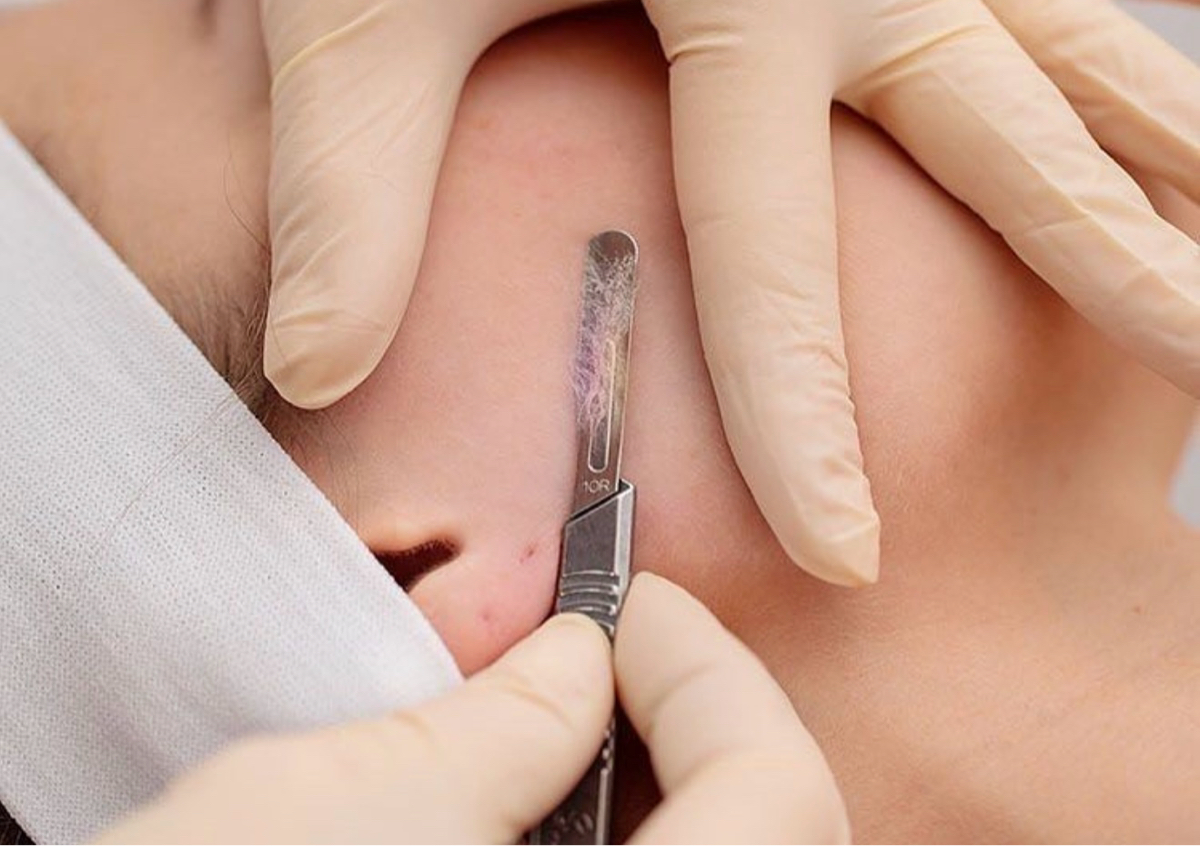 Dermaplaning 