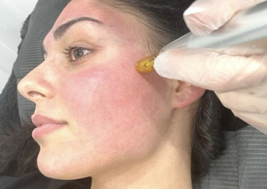 Skin needling package