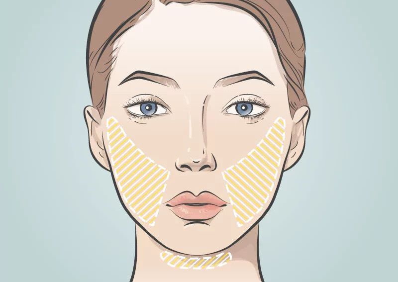 HIFU Cheeks & Submentum