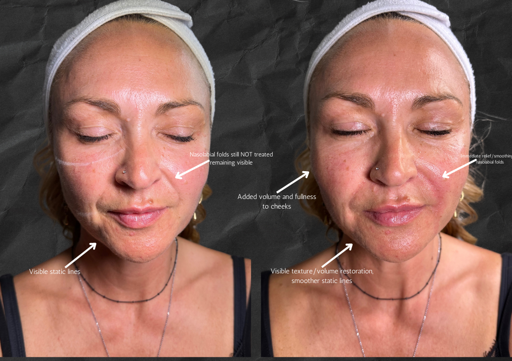 Platelet Rich Fibrin