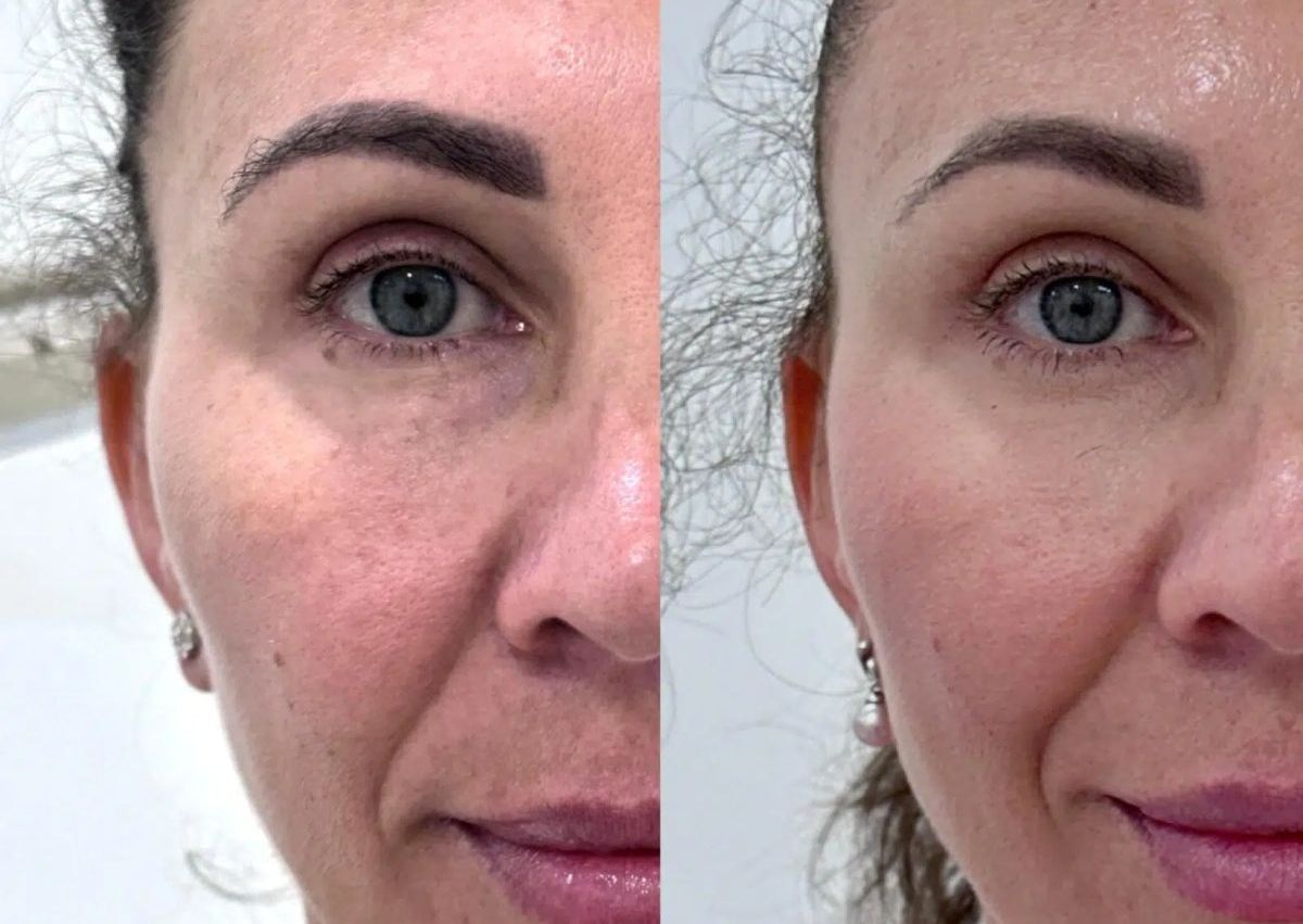 Rejuran Classic (for whole face)