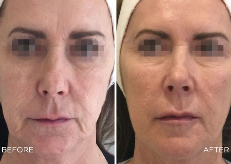 Profhilo (Skin Remodelling Treatment)