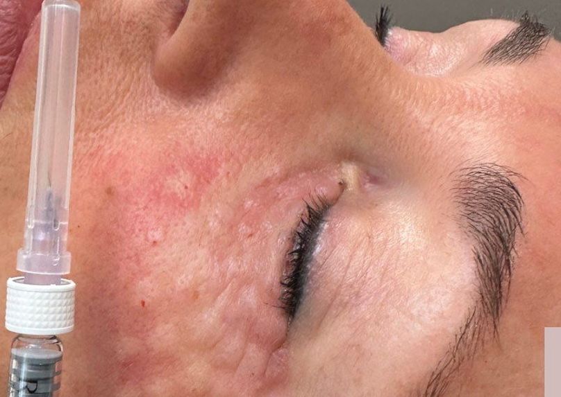 Rejuran i (for eyes)