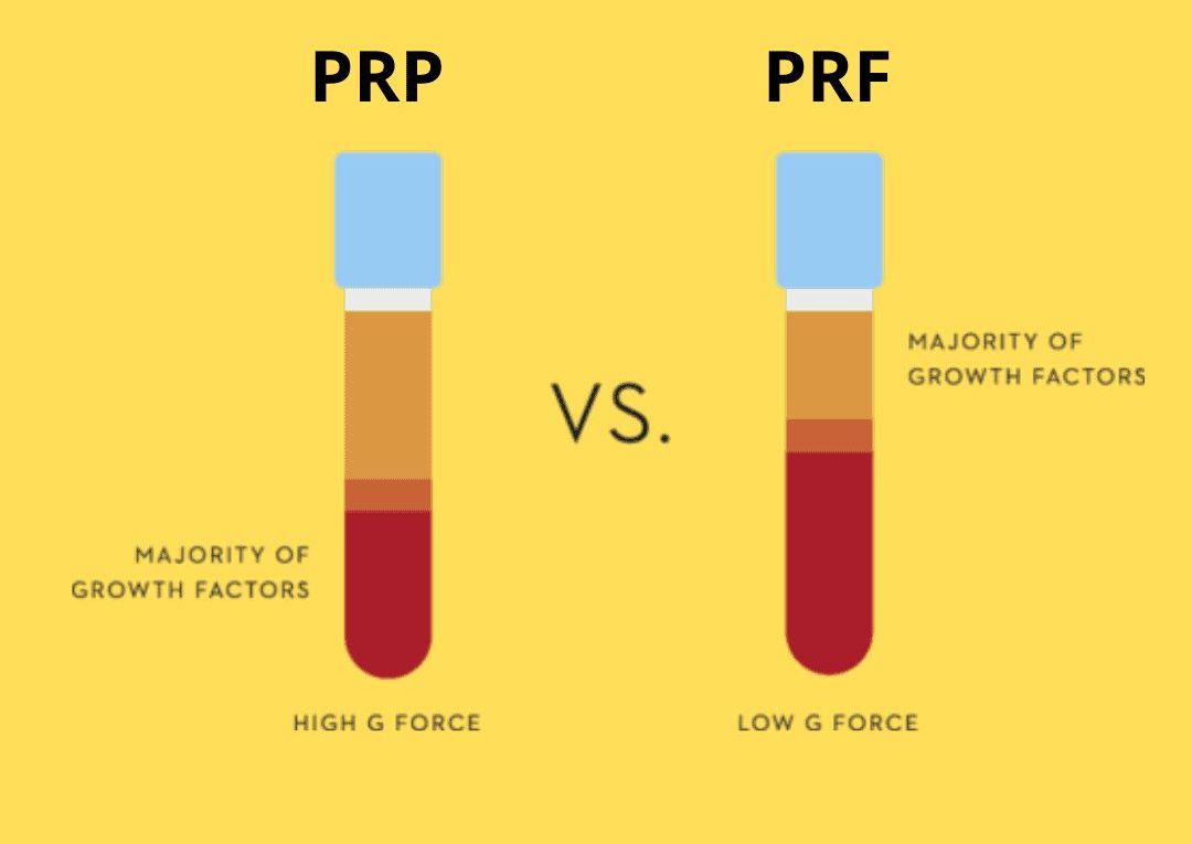 Platelet Rich Plasma