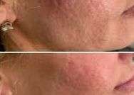 Rejuran S (for scarring)