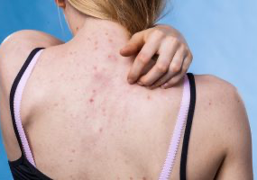 Acne Back Facial ( women only)