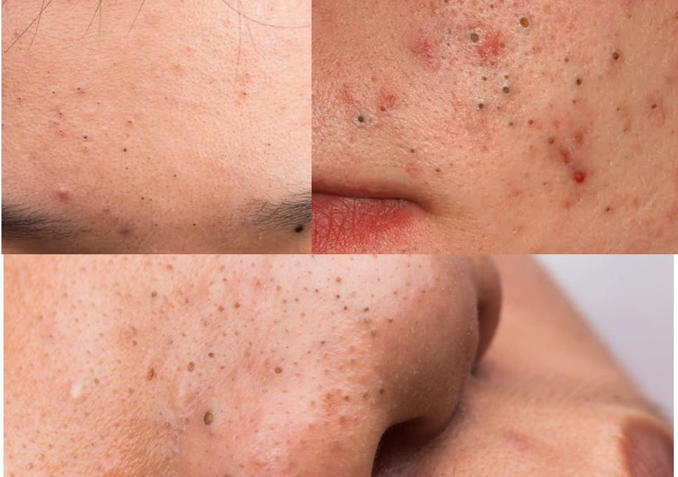 Blackhead removal ( add on service) cannot be booked by it self schedule to add on with  facial