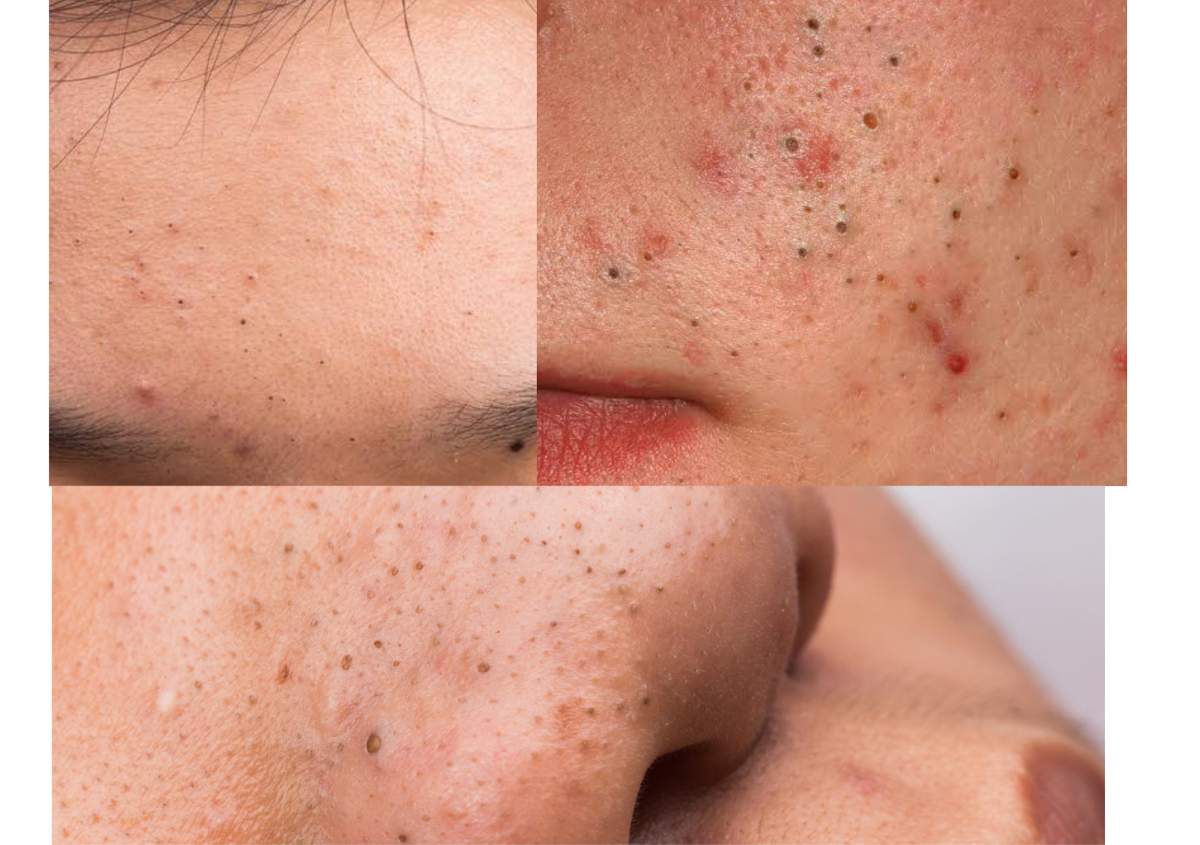 Extraction facial (Black head removal)