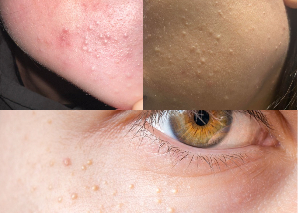 Milia removal (whitehead) add on Service cannot be booked by it self schedule to add on with  facial