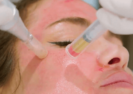 Microneedling treatment (Face & neck)