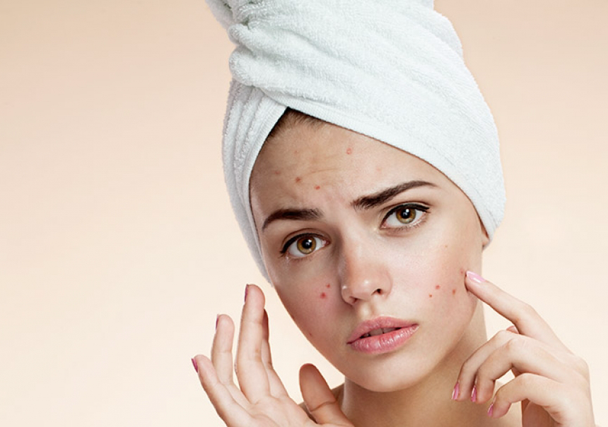 Acne facial 
