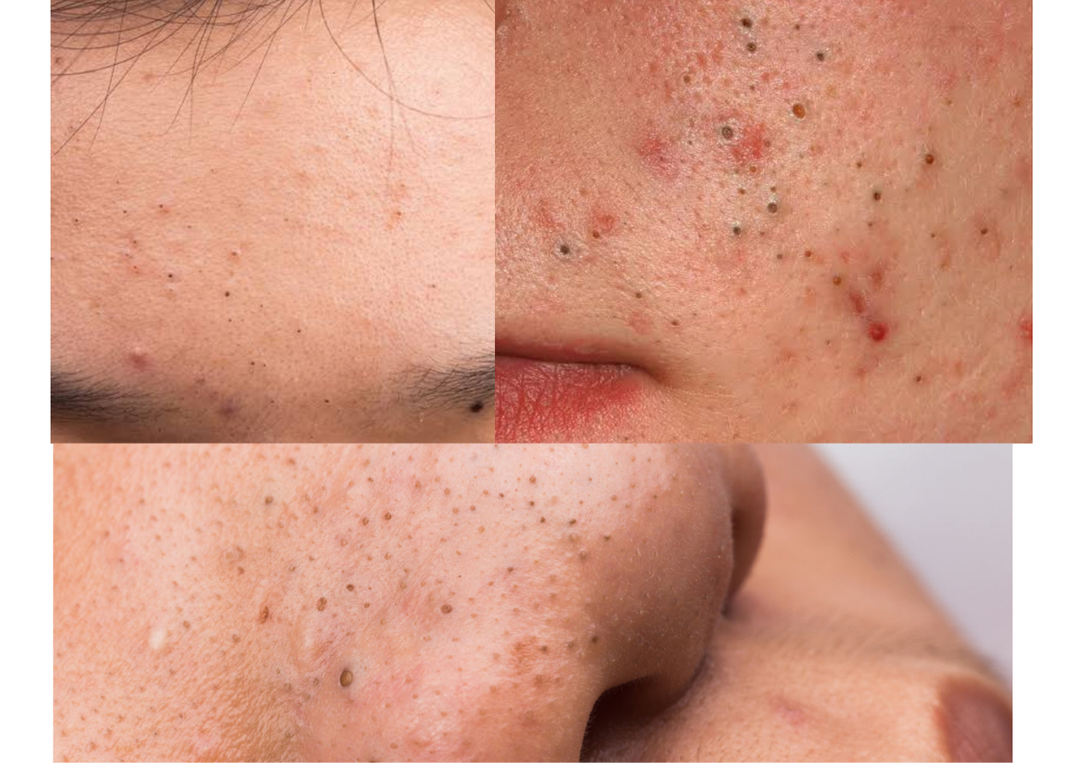 Blackhead removal (15 minutes )( add on service) cannot be booked by it self schedule to add on with facial.