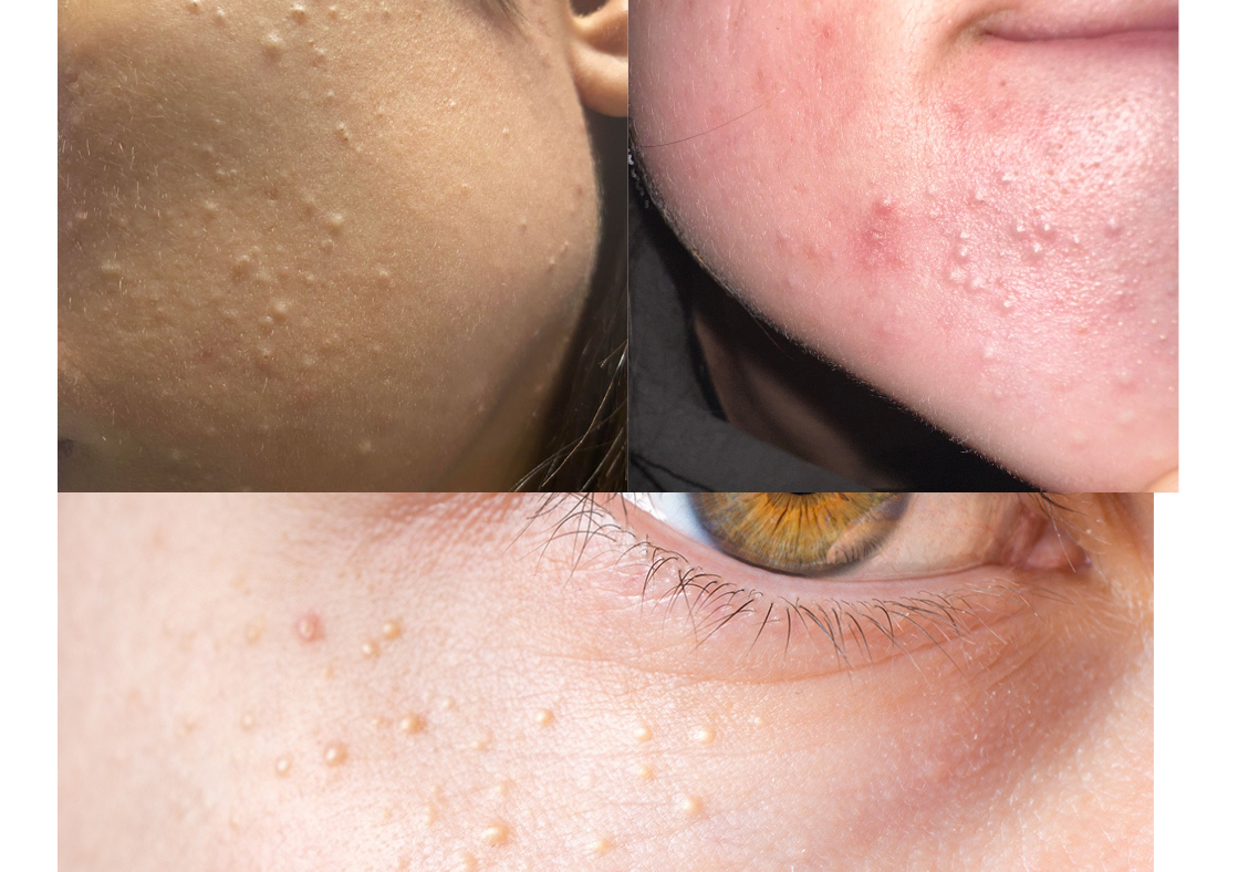 Milia removal (whitehead) add on Service cannot be booked by it Schedule to add on with  facial