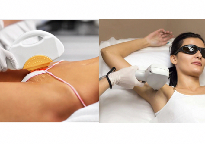 Private areas package 6 sessions (Full Brazilian & Under arms)