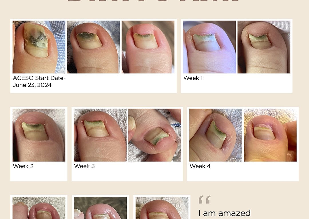 Tratamiento Curativo Aceso de Hongos y Bacterias en Uñas y  Pie De Atleta 