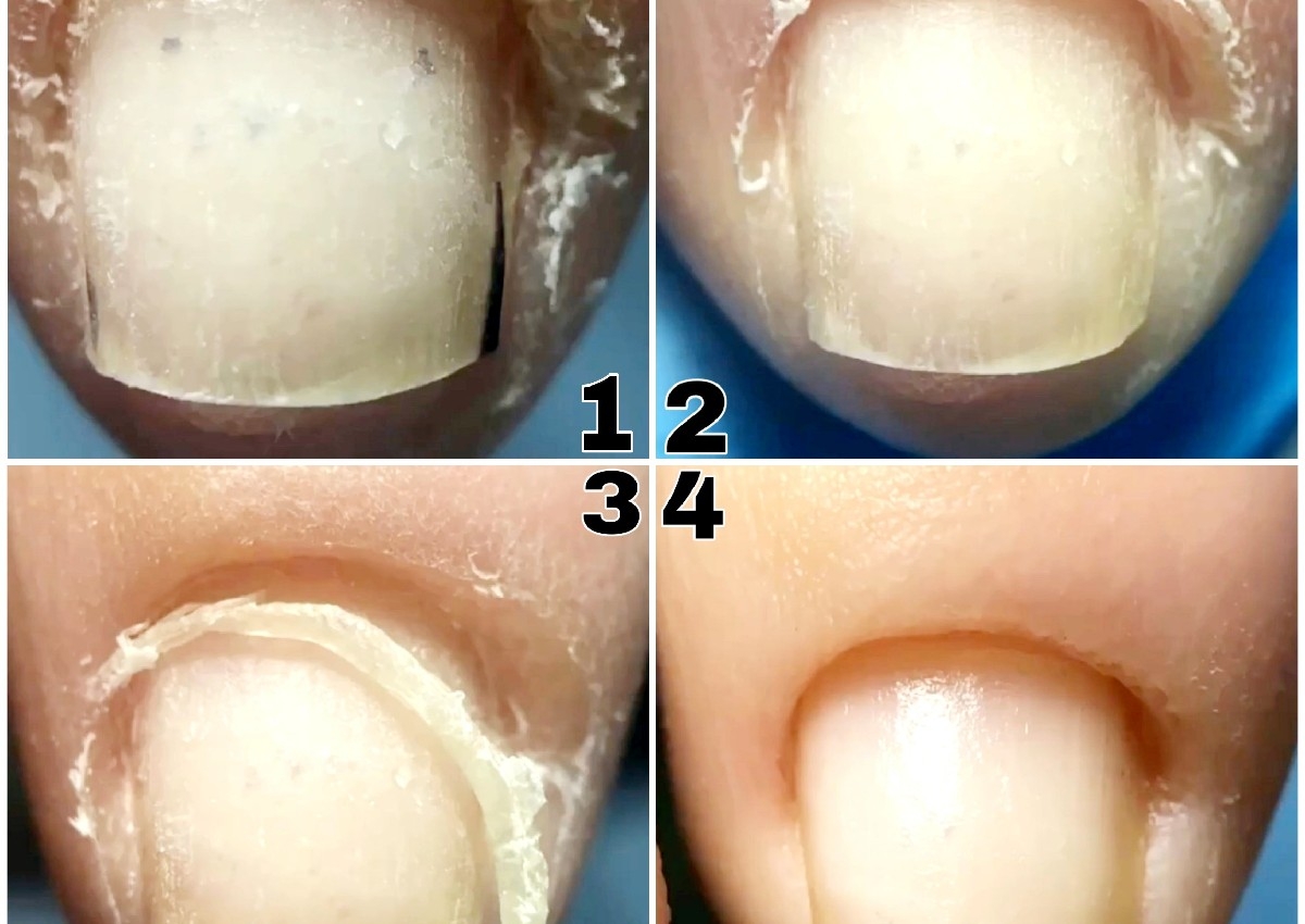 Limpieza de Cuticulas Profundas 