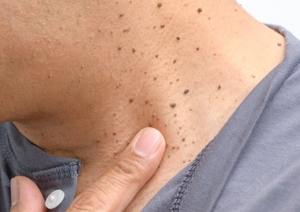 Remocion de Verrugas o Skin tags