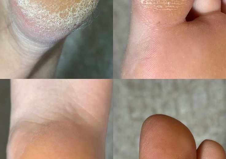 Callus remove 