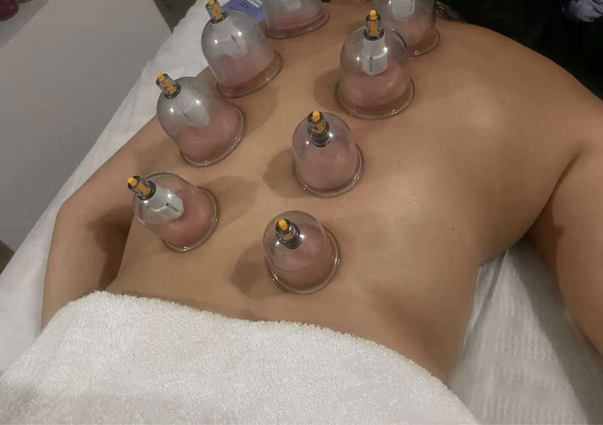 Masaje con ventosas 