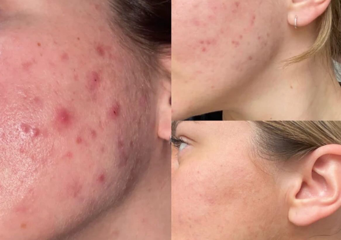 LIMPIEZA FACIAL DE ACNÉ MODERADO.