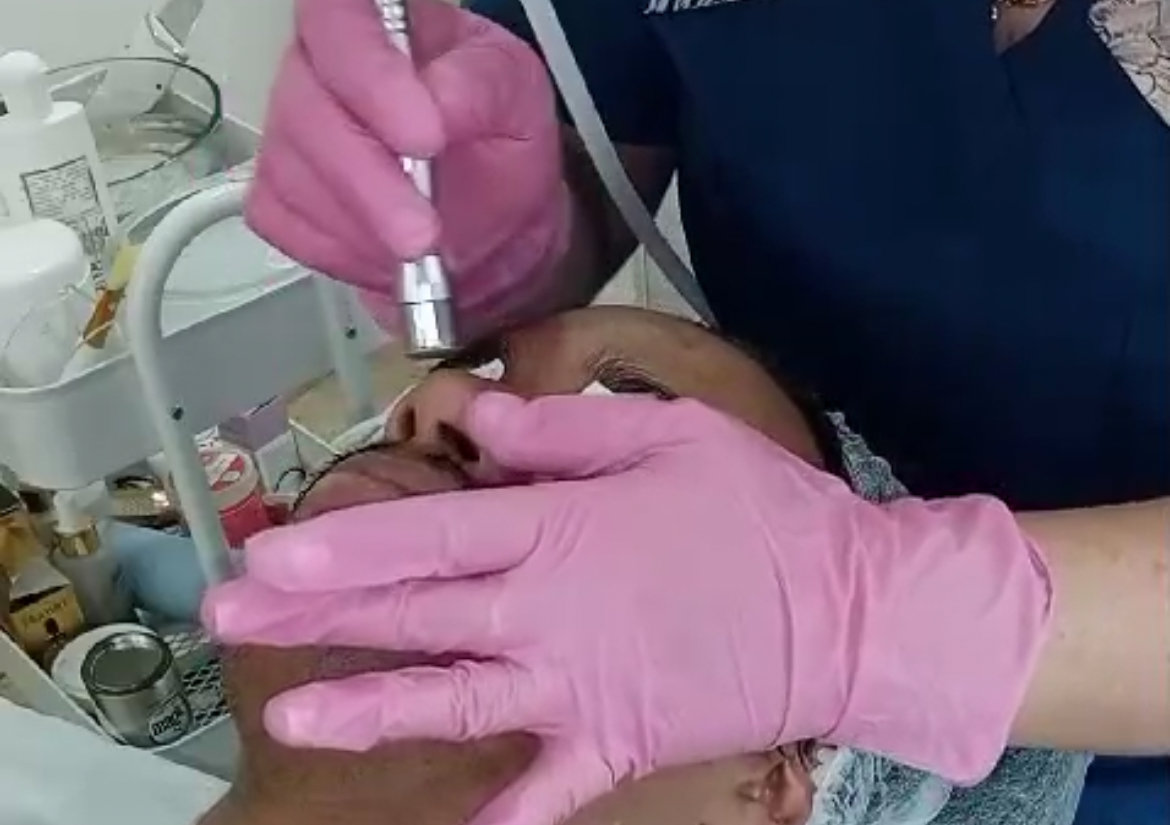 MICRODERMOBRASIÒN FACIAL