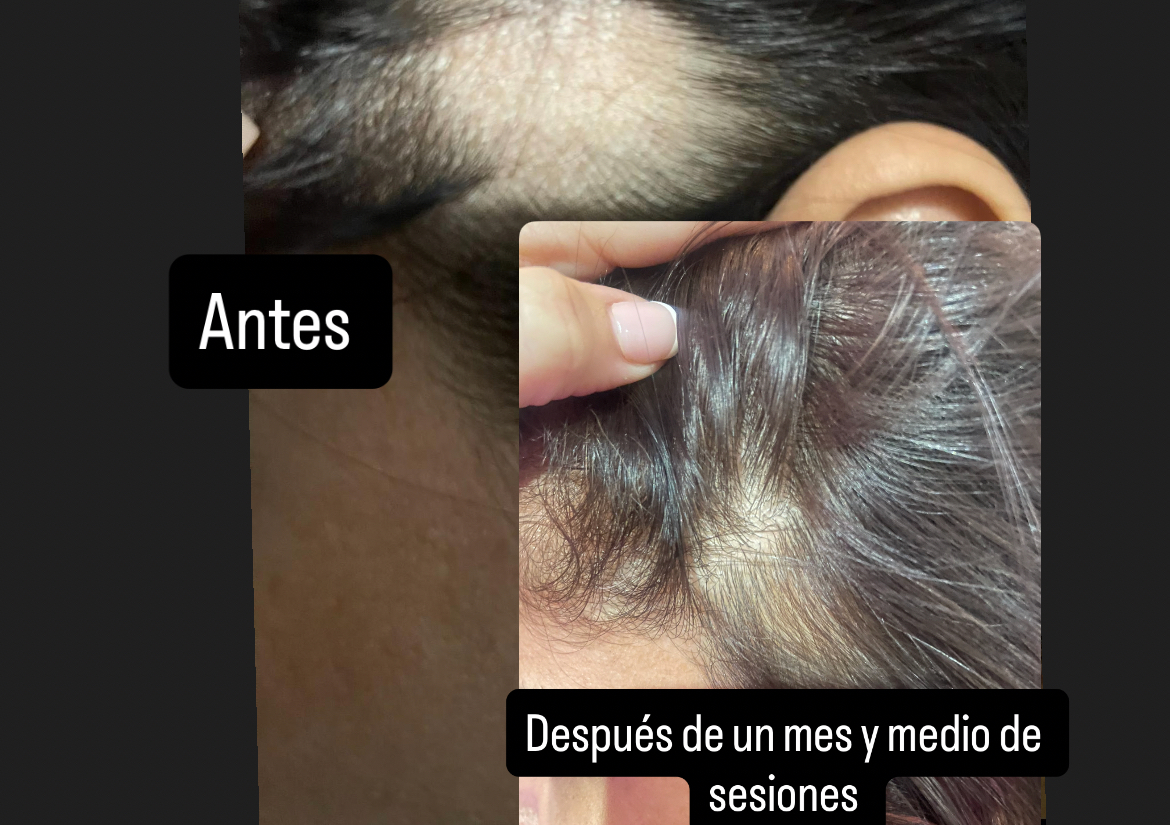 TRATAMIENTO CAPILAR LES (Tricologia)